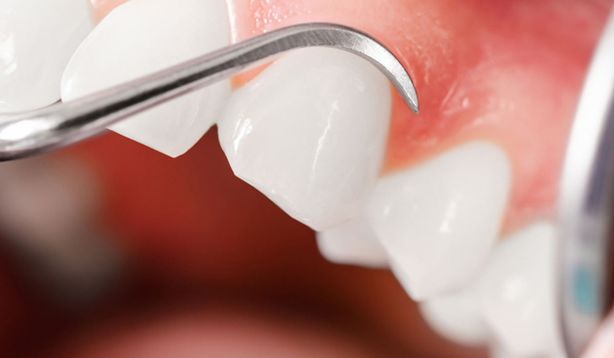 歯周病の原因について