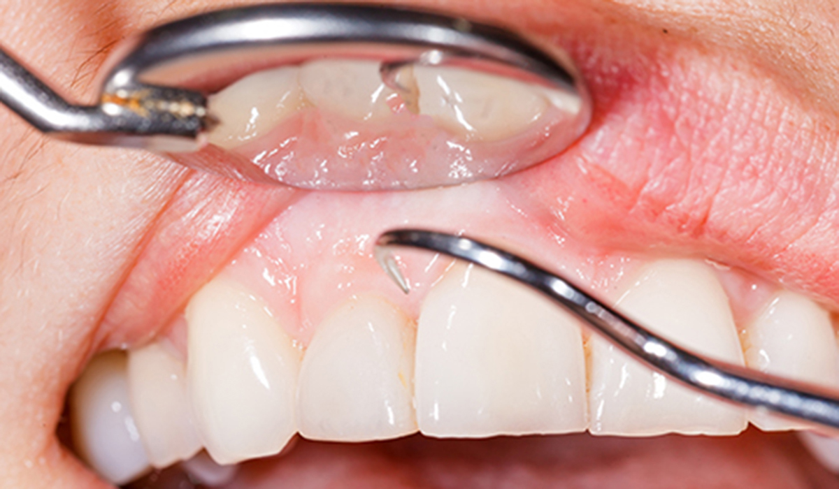 歯周外科治療の種類